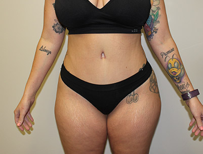 Tummy Tuck before and after - after