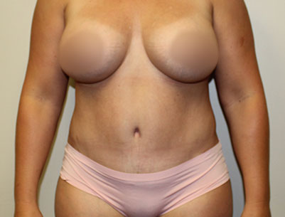 Tummy Tuck before and after - after