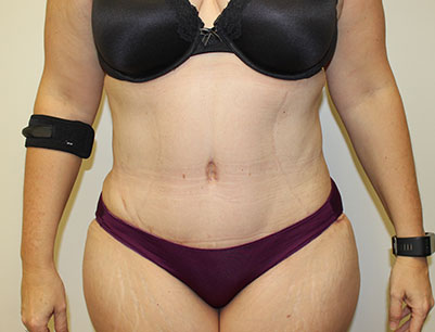Tummy Tuck before and after - after