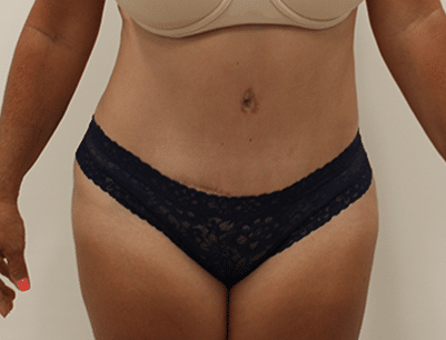 Tummy Tuck before and after - after