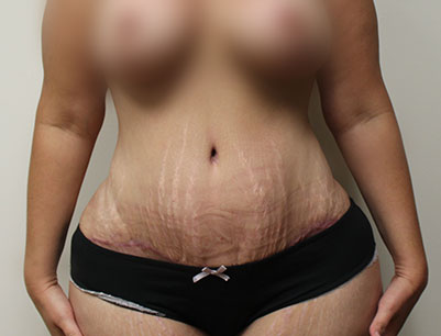 Tummy Tuck before and after - after