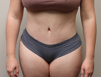 Tummy Tuck before and after - after