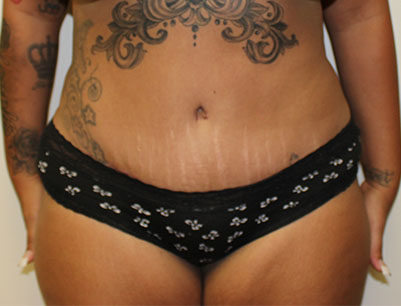 Tummy Tuck before and after - after