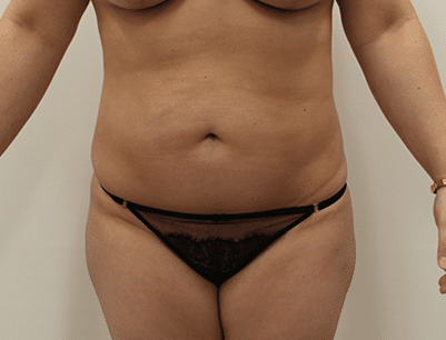 Liposuction before and after - after