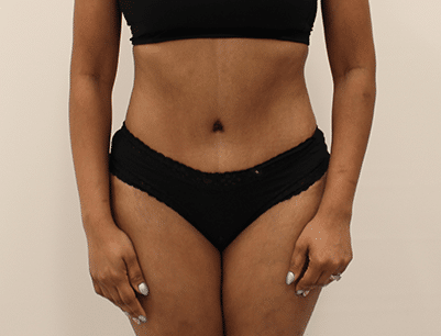 Tummy Tuck before and after - after