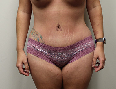 Tummy Tuck before and after - after