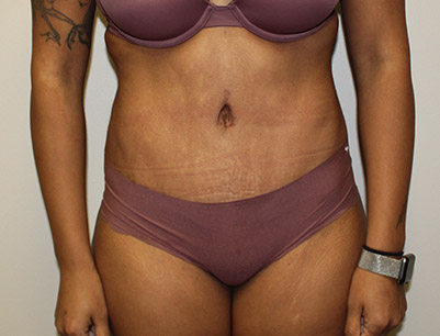 Tummy Tuck before and after - after