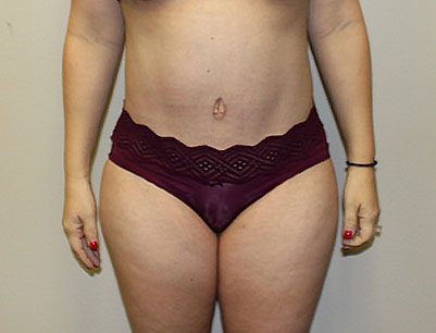 Tummy Tuck before and after - after