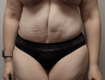 Tummy Tuck before and after - after