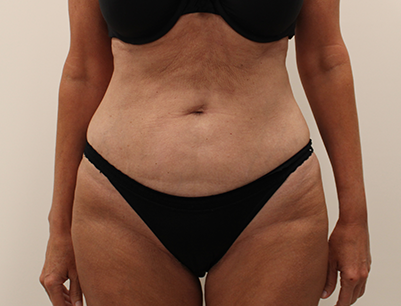 Liposuction before and after - after