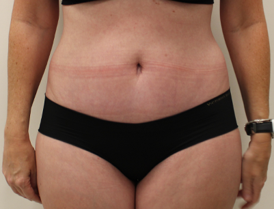 Tummy Tuck before and after - after