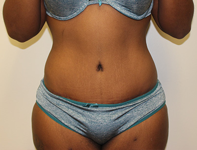 Tummy Tuck before and after - after