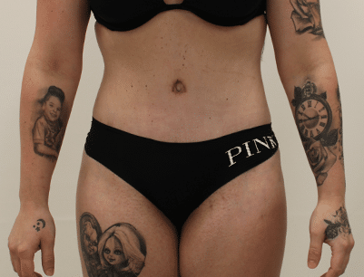 Tummy Tuck before and after - after