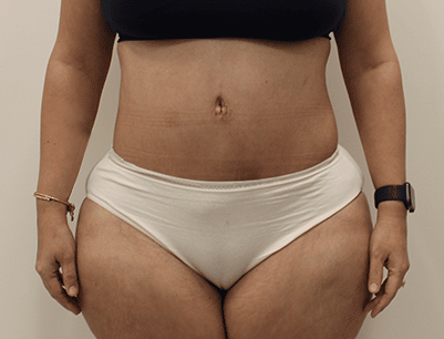 Tummy Tuck before and after - after