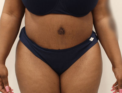 Tummy Tuck before and after - after