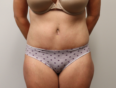 Tummy Tuck before and after - after