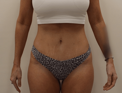 Tummy Tuck before and after - after