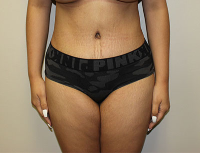 Tummy Tuck before and after - after