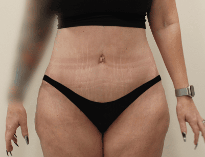 Tummy Tuck before and after - after