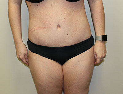 Tummy Tuck before and after - after