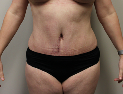 Tummy Tuck before and after - after