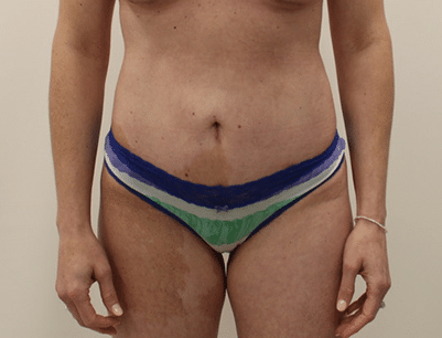 Tummy Tuck before and after - after