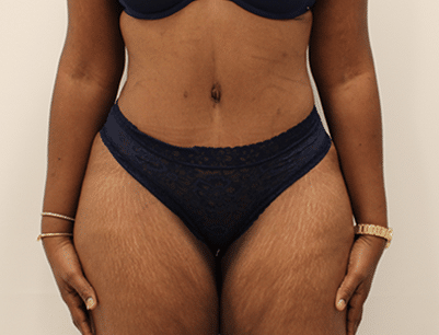 Tummy Tuck before and after - after