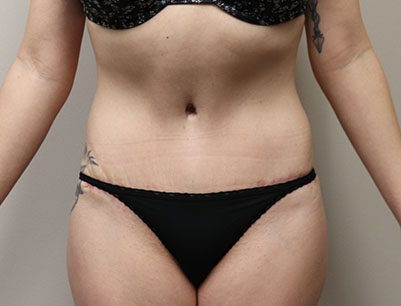 Tummy Tuck before and after - after