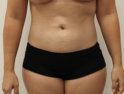 Liposuction before and after - after