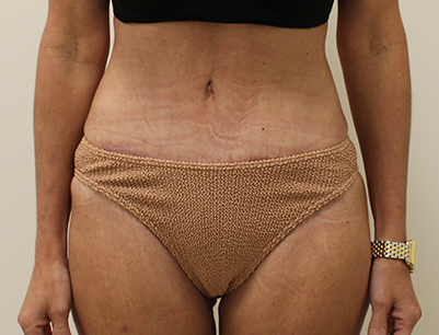 Tummy Tuck before and after - after