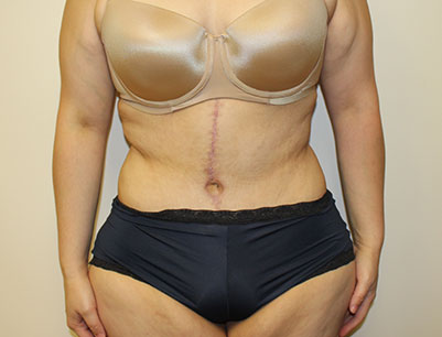 Tummy Tuck before and after - after