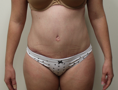 Tummy Tuck before and after - after
