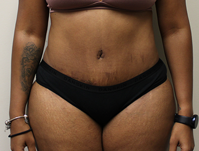 Tummy Tuck before and after - after