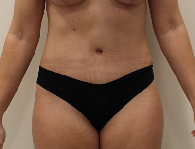Tummy Tuck before and after - after