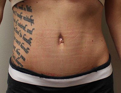 Tummy Tuck before and after - after