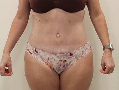 Tummy Tuck before and after - after