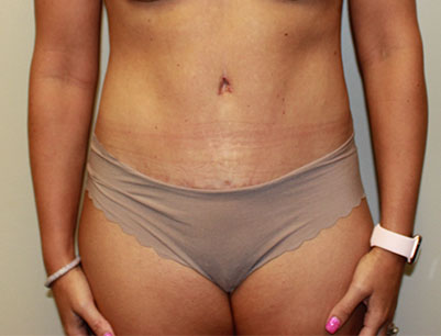 Tummy Tuck before and after - after