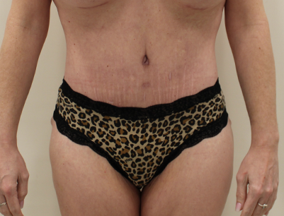 Tummy Tuck before and after - after