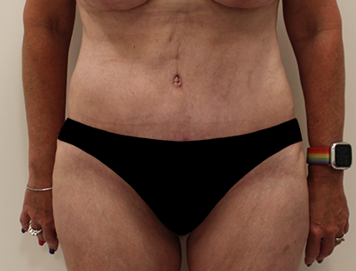 Tummy Tuck before and after - after