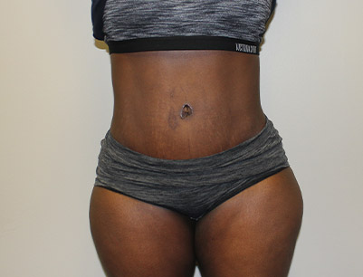 Tummy Tuck before and after - after