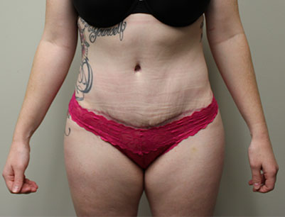 Tummy Tuck before and after - after