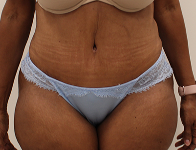 Tummy Tuck before and after - after