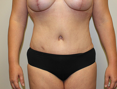 Tummy Tuck before and after - after