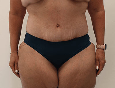 Tummy Tuck before and after - after