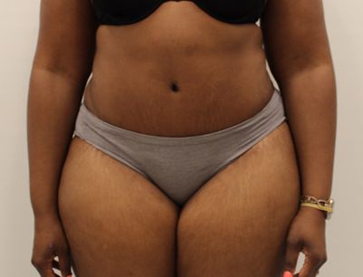 Tummy Tuck before and after - after