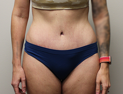 Tummy Tuck before and after - after
