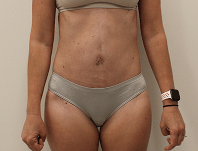 Tummy Tuck before and after - after