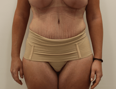 Tummy Tuck before and after - after