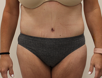 Tummy Tuck before and after - after