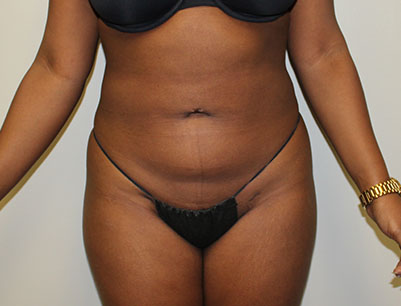 Liposuction before and after - after